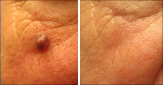 laser vein removal